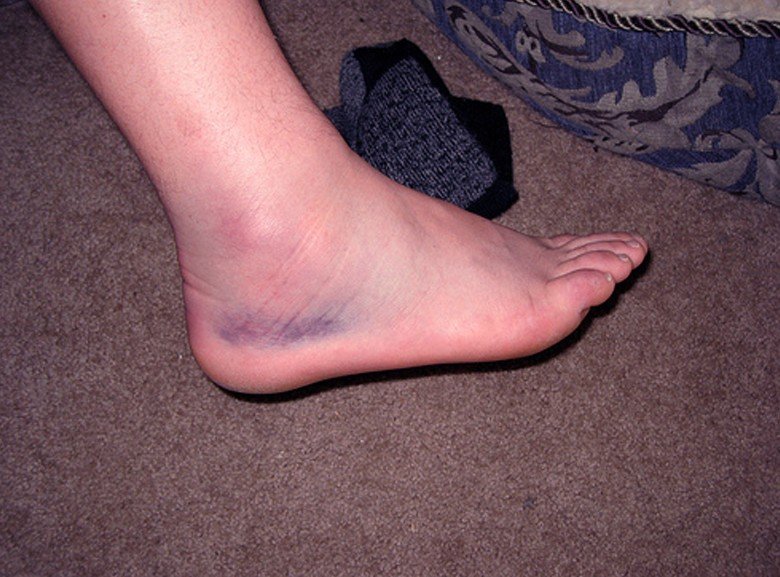 swollen-ankles-treatment-pictures-pregnancy-symptoms-causes