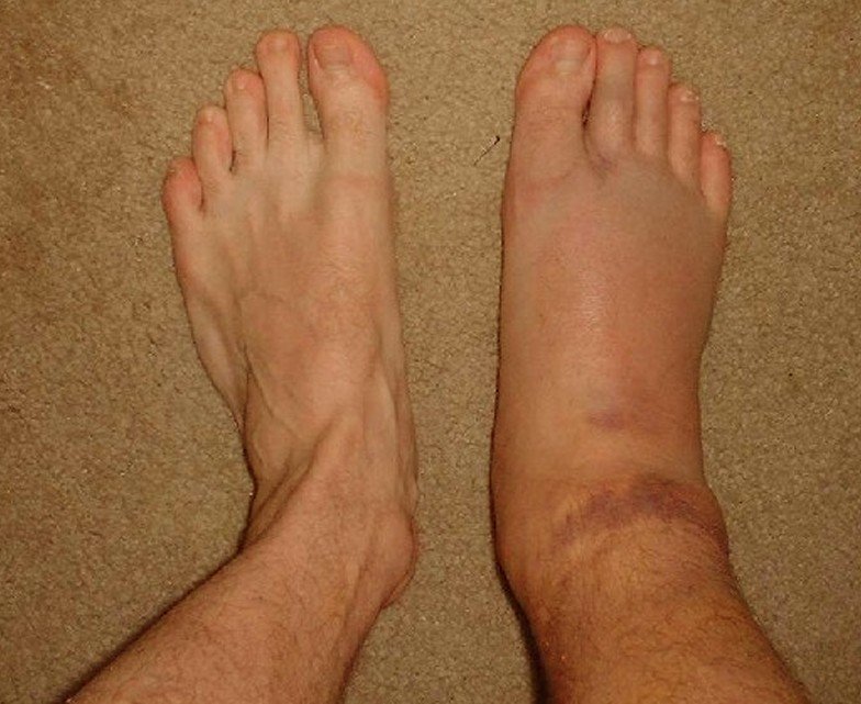 Gout In Ankle Pictures - isgout.com