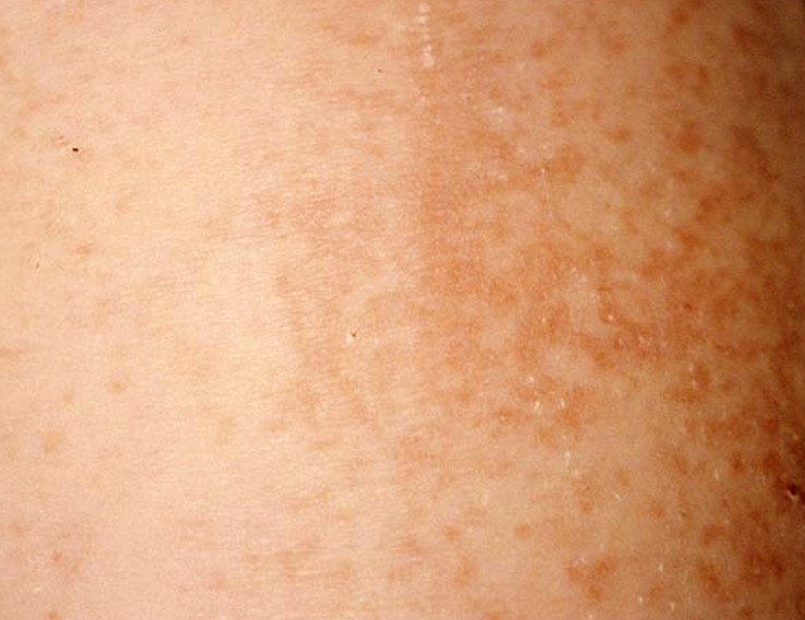 The Generalized Rash: Part I. Differential Diagnosis ...
