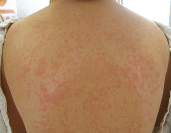 Is Maculopapular Rash Dangerous