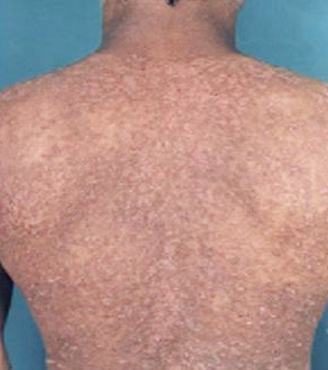 maculopapular-rash-pictures-causes-treatment-diagnosis