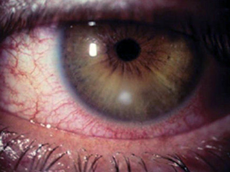 Corneal Ulcer Pictures Symptoms Causes Treatment