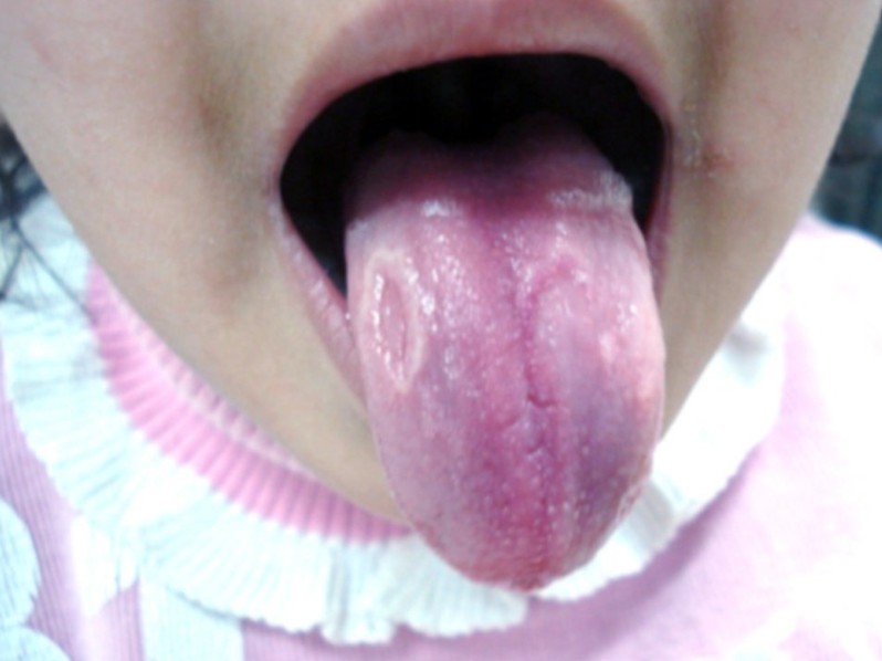 geographic tongue symptoms #9