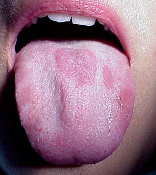 Geographic Tongue - Pictures, Causes, Symptoms, Pain and ...