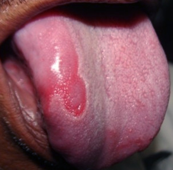 Geographic Tongue --- Top 10 Causes and Cures