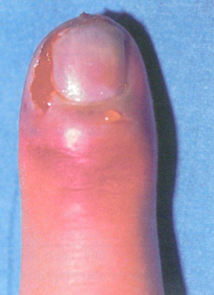 Herpetic Whitlow - Pictures, Treatment, Contagious, Symptoms