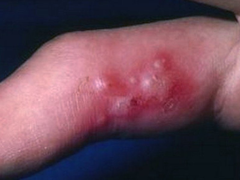 herpetic whitlow symptoms