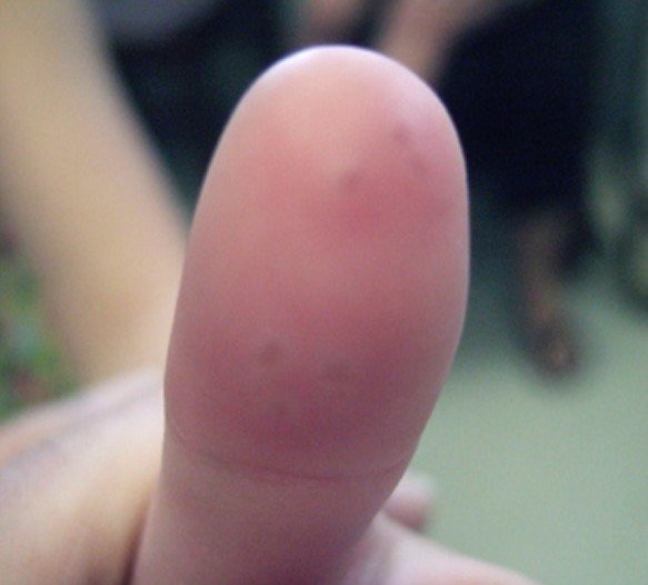 Pictures of Viral Skin Diseases and Problems - Herpetic ...