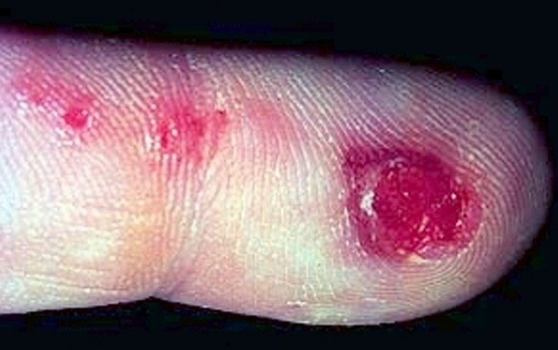 Herpetic whitlow contagious - Herpes - MedHelp