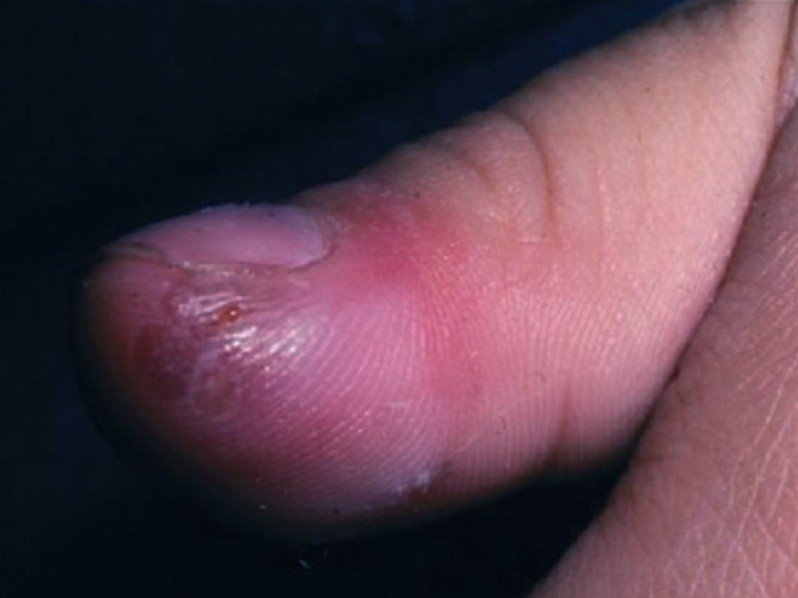 Herpes Virus Gives Man a Blistery Finger Infection