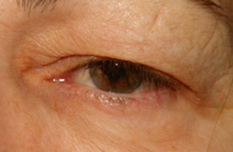 Clogged Tear Duct In Adults 74