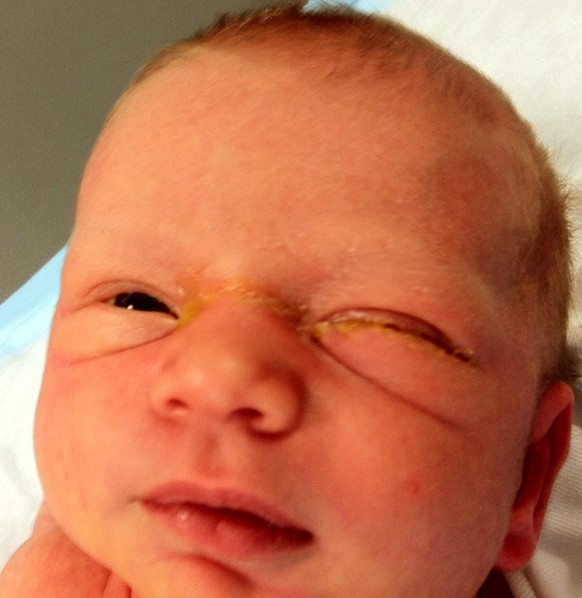 pink eye in infants #10