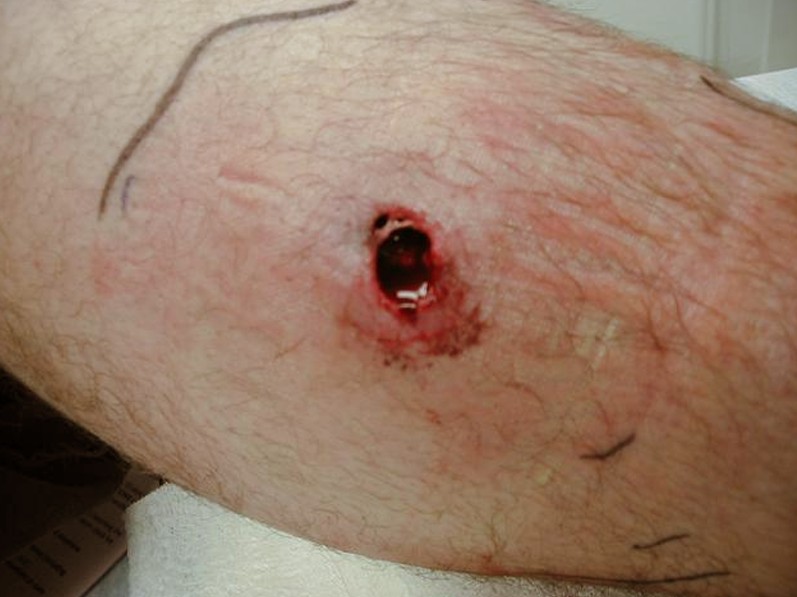 pictures of recluse spider bite