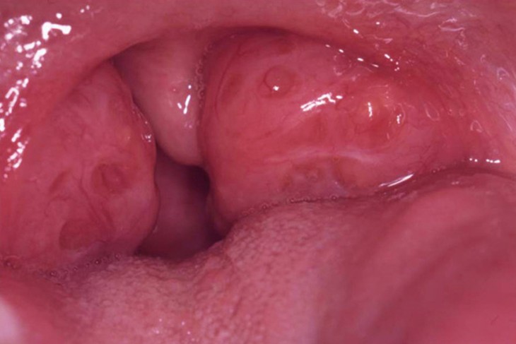 Enlarged Throat 24