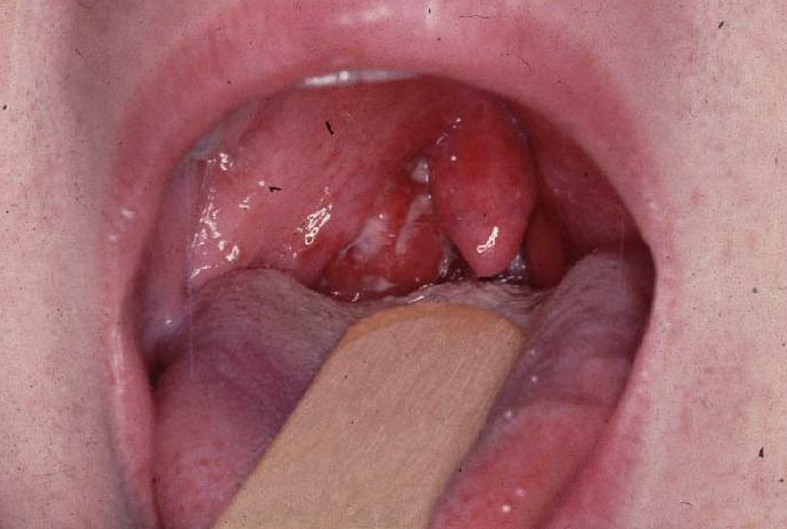 Enlarged Tonsils Adult 60