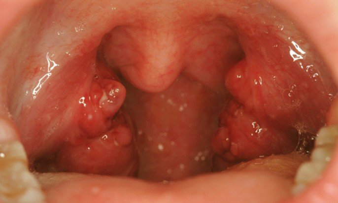 Enlarged Tonsils Adult 99