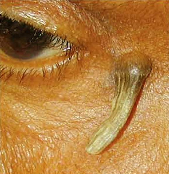 Cutaneous Horn - Causes, Characteristics and Treatment