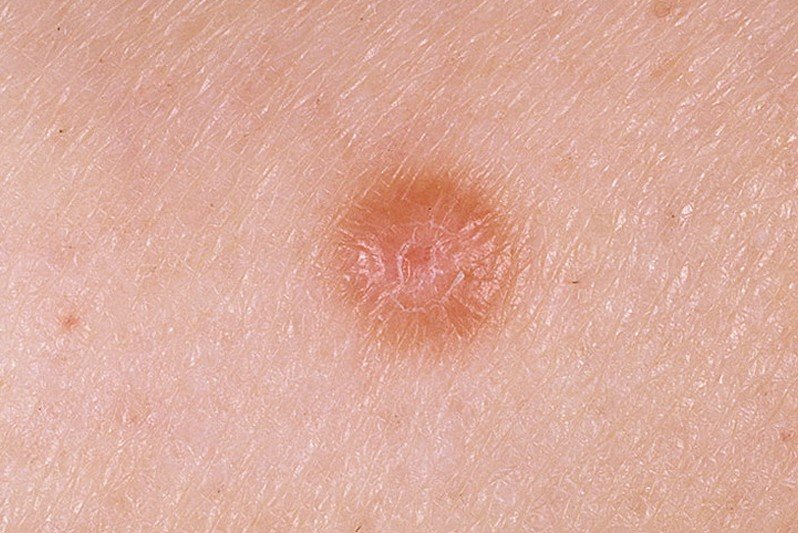 Dermatofibroma – Pictures, Causes, Removal and Treatment