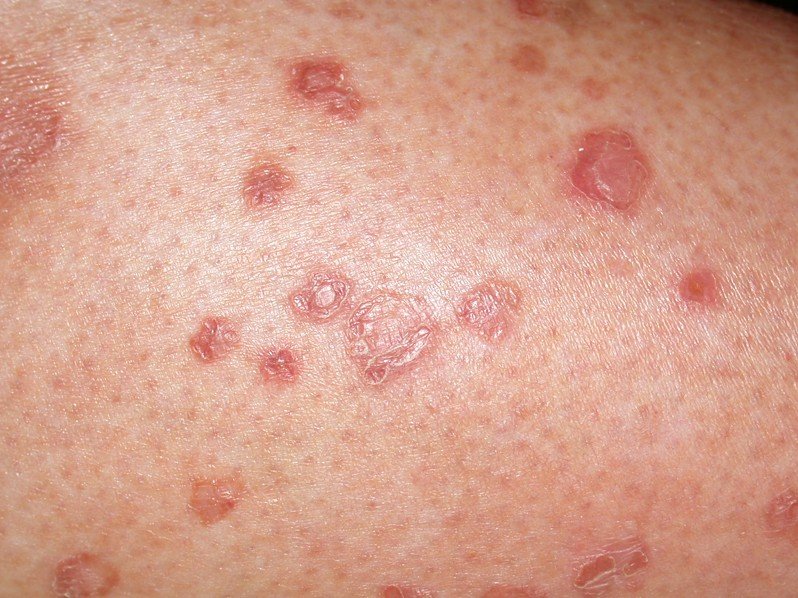 Rashes | Associates In Dermatology