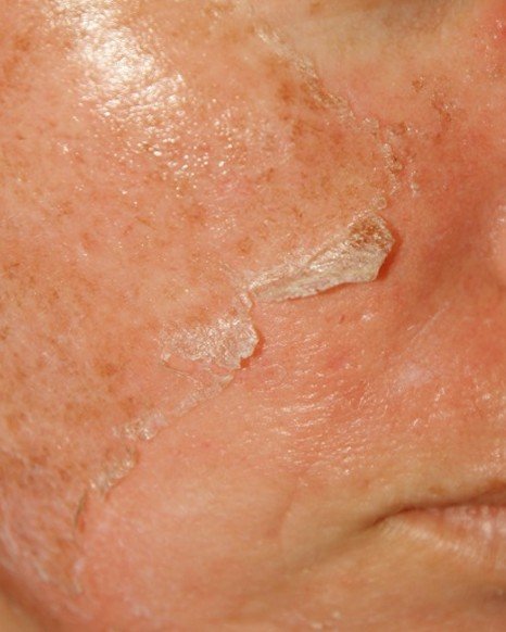 flaky-skin-symptoms-treatment-causes-pictures