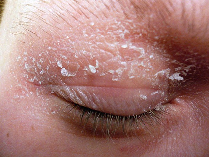 dry eyelids #10