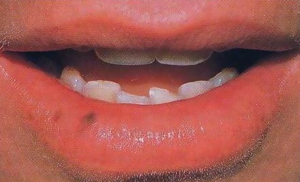 Oral Melanotic Macules 108