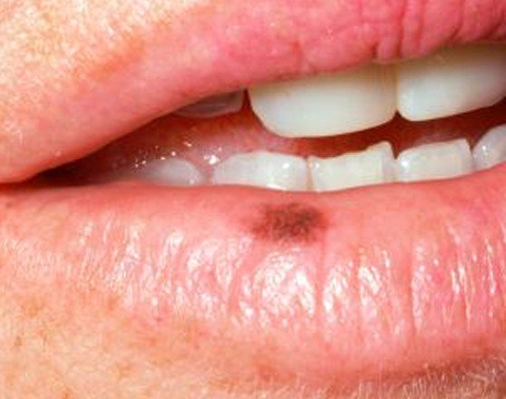 What Causes Cracked Lips On The Side