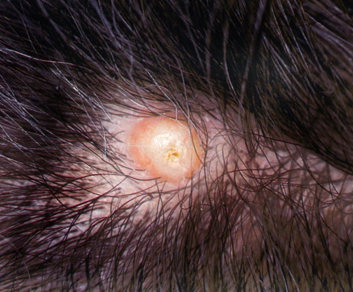 pilar cysts scalp #10