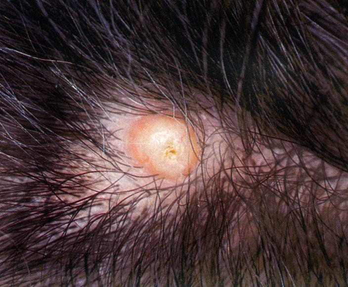 Large Sebaceous Cyst Scalp Removal Surgery