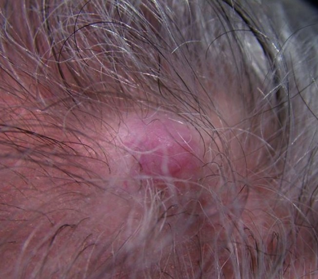 pilar cysts on scalp