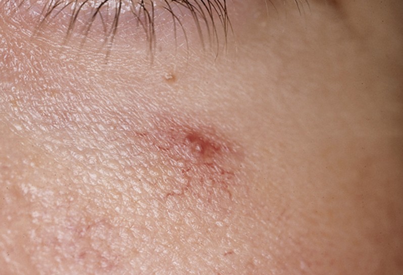 Spider Angioma - Treatment, Causes, Pictures, Diagnosis