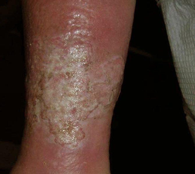 Chronic Venous Stasis Dermatitis Icd