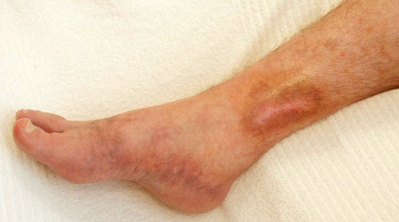 Another Name For Venous Stasis Syndrome