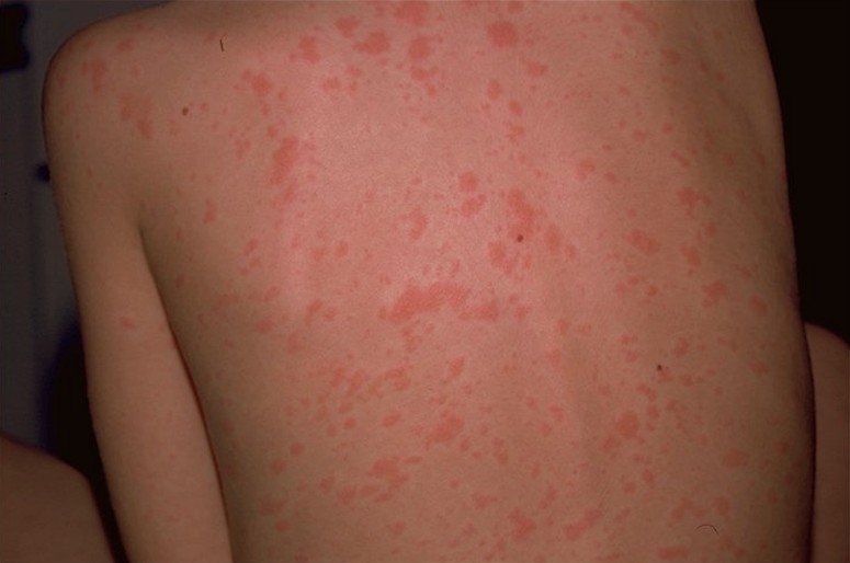 Viral Rash Adults 15