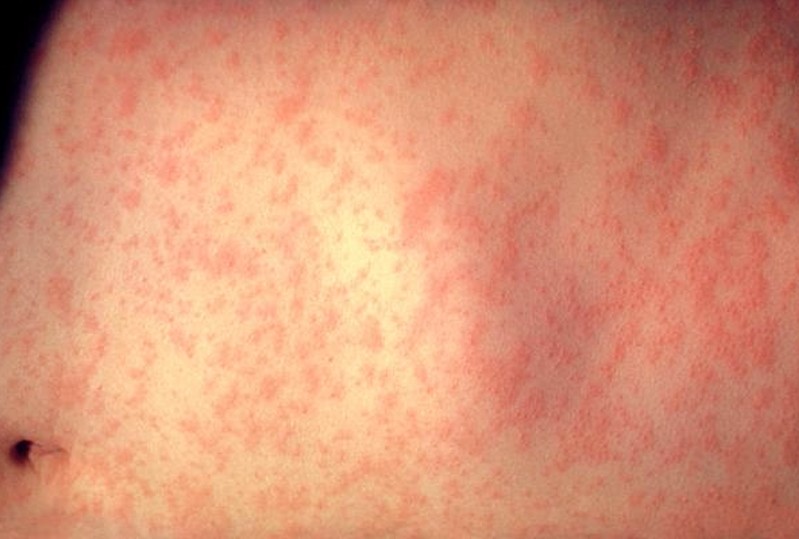 Viral Exanthem in Adults: Condition, Treatments, and ...
