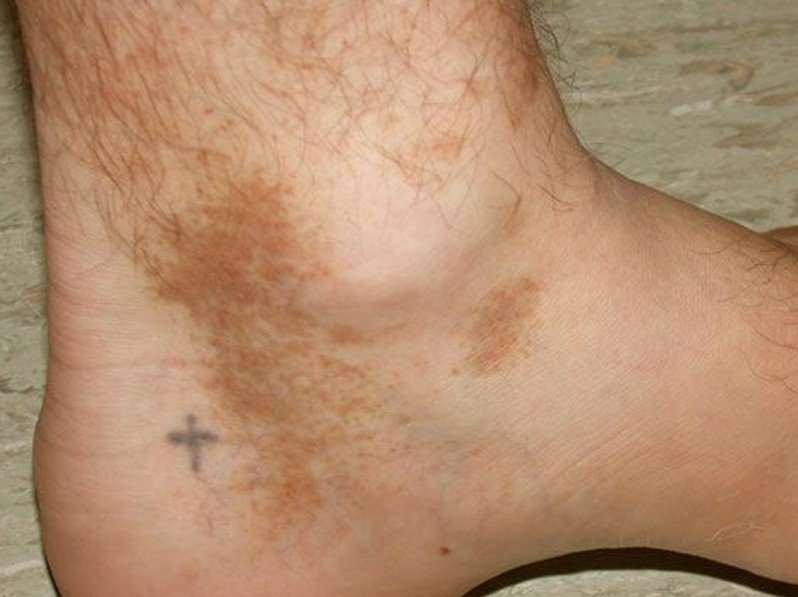 red splotches on lower legs pictures, photos