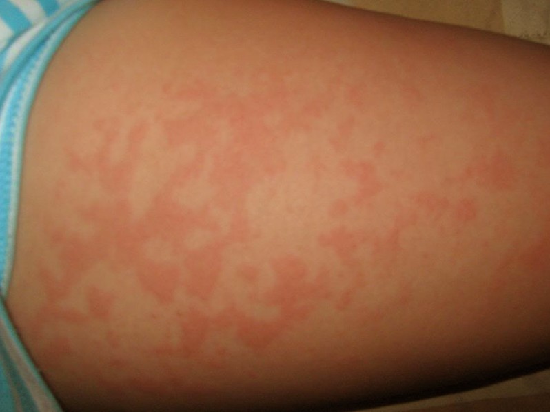 Schamburg's Disease Causes Red Spots On The Legs ...