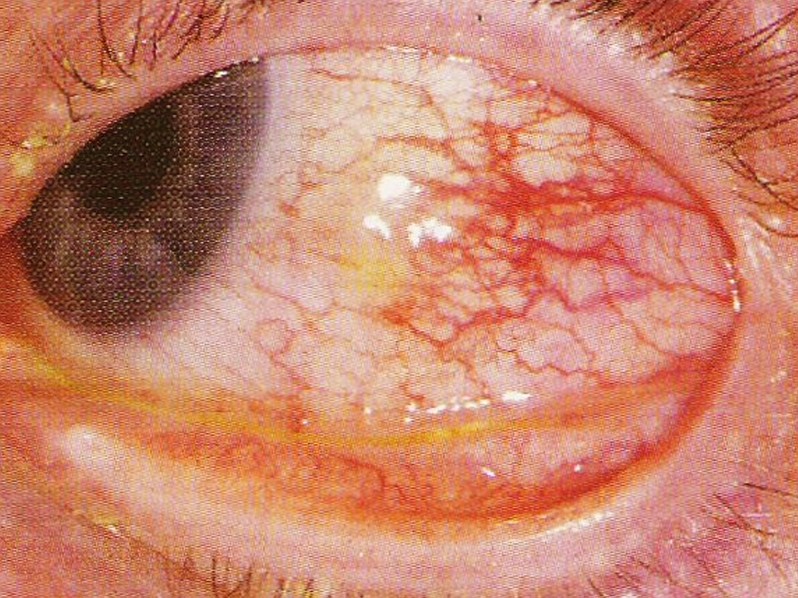 Systemic Lupus Erythematosus Detached Retina Histoplasmosis Stye ...