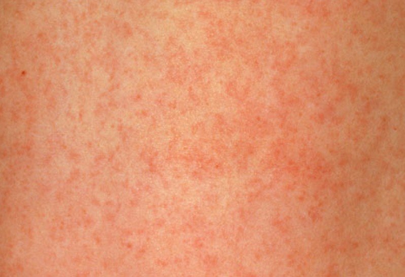 Rubella (German Measles) - MedicineNet