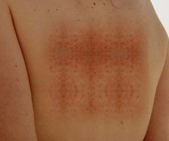 Herpetic Whitlow - Pictures, Treatment, Contagious, Symptoms