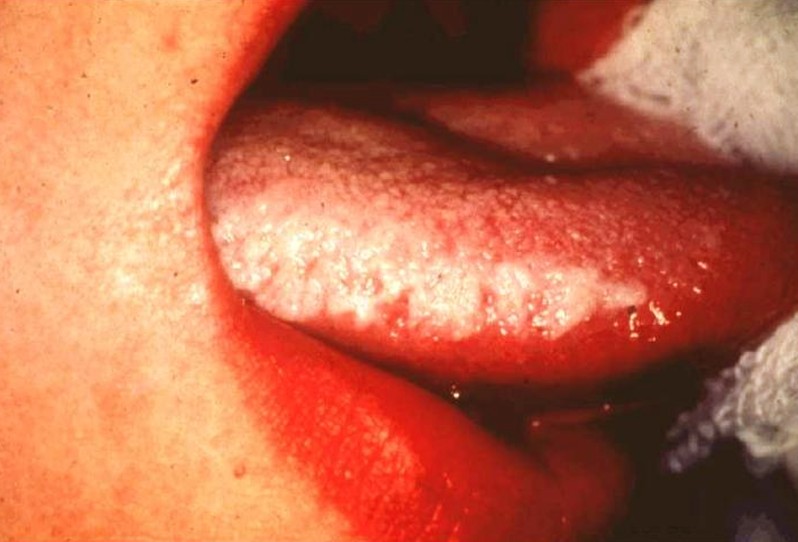 Hairy Leukoplakia Of Tongue 83