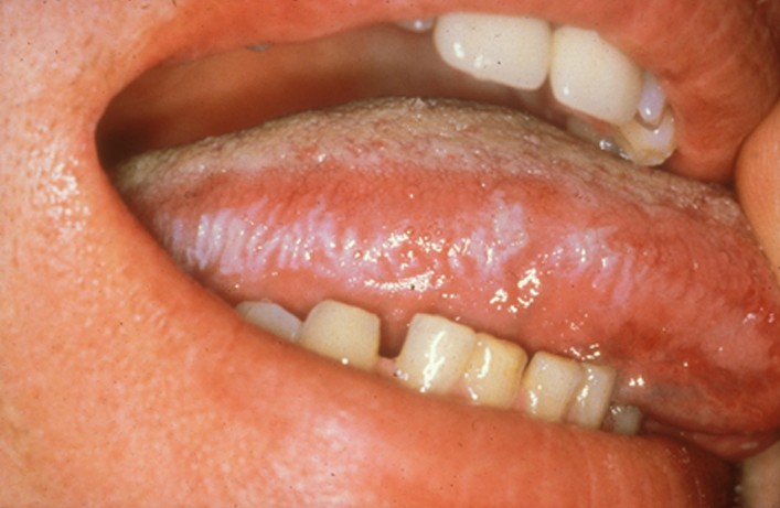 Hairy Leukoplakia Of Tongue 27
