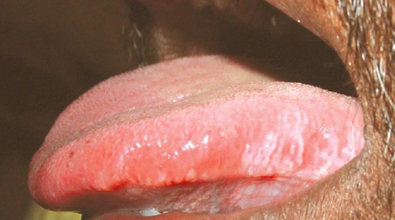 Hairy Tongue Leukoplakia 60