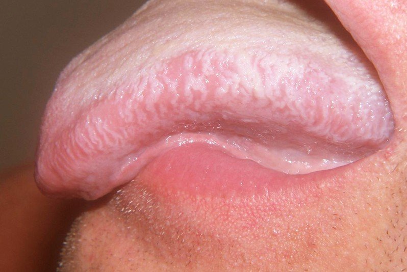 Hairy Leukoplakia 96