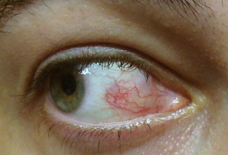 What are some treatments for a blister on the surface of the eye?