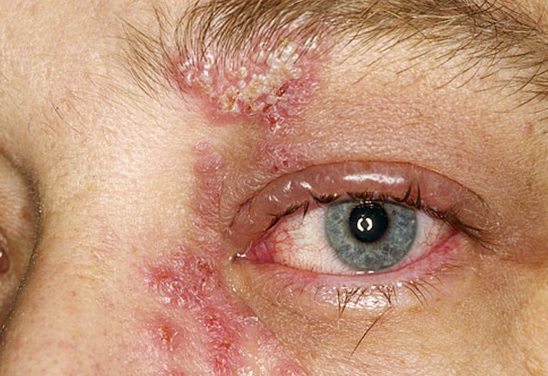 Alfa img - Showing &gt; Herpes Simplex Eye Infection
