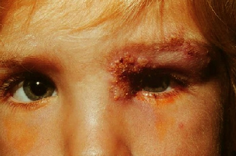 eyelid dermatitis #11