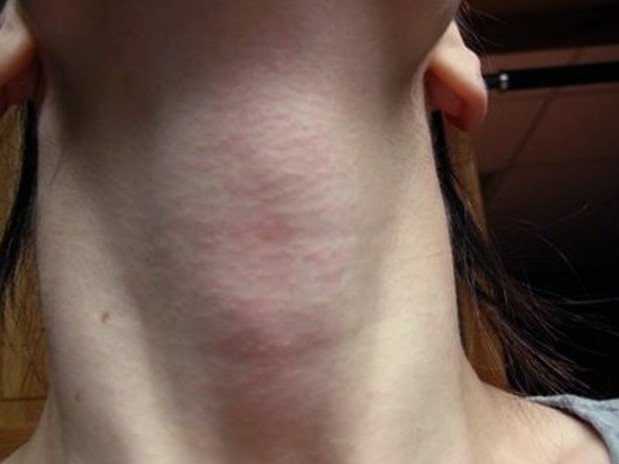 itchy-neck-pictures-symptoms-treatment-rash-causes