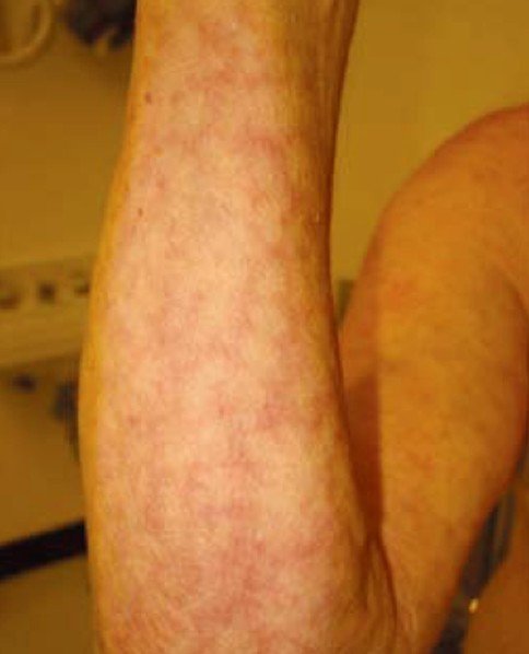 Livedo Reticularis - Pictures, Symptoms, Causes, Diagnosis ...