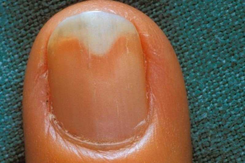 what-causes-sore-nail-beds-at-joanne-ledoux-blog